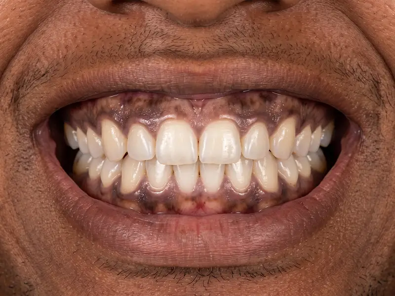 Before gum bleaching