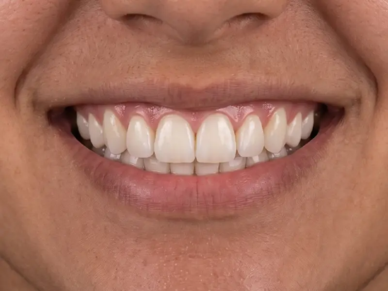 After Gum Contouring
