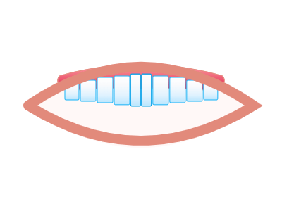 After Hollywood Smile Makeover