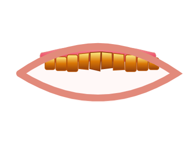 Before Hollywood Smile Makeover