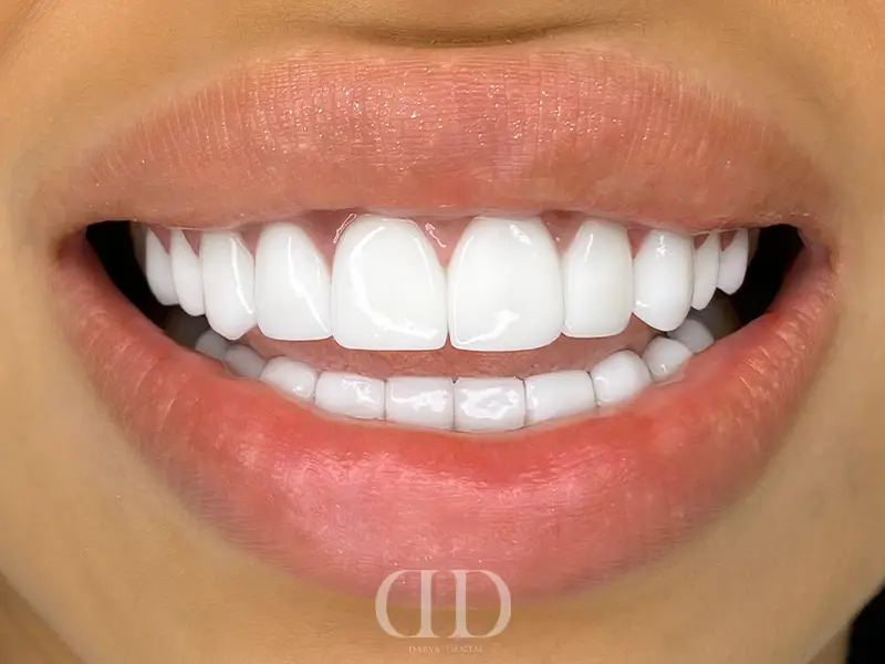 After Hollywood Smile Makeover