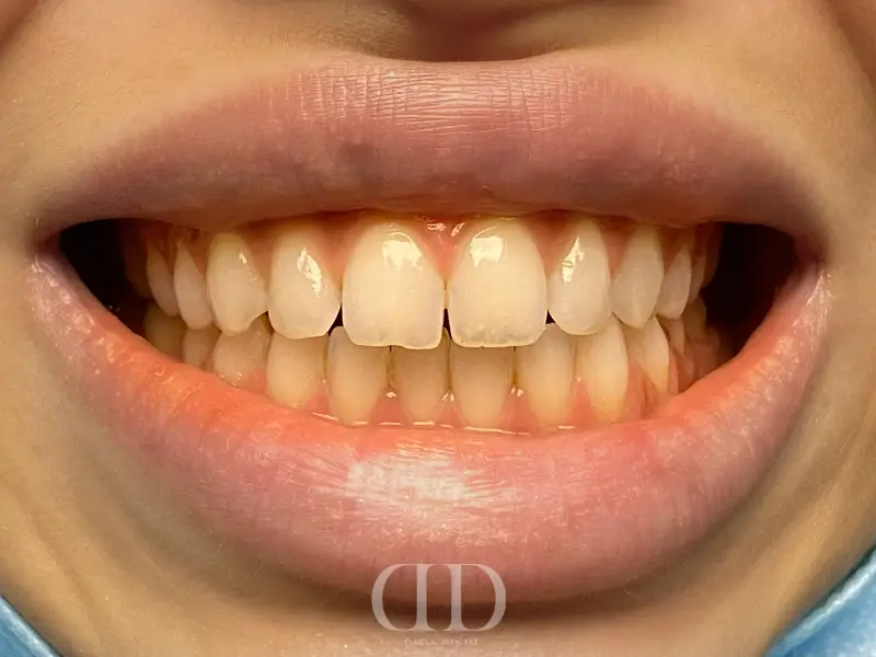 Before Hollywood Smile Makeover