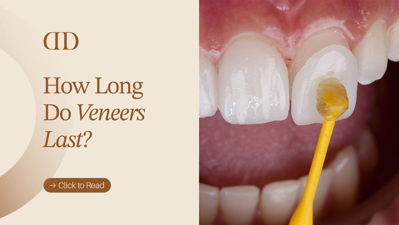 Veneers