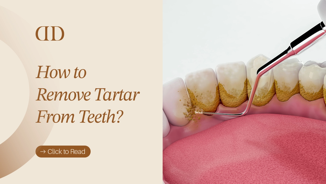 Illustration showing how to remove tartar from teeth using proper oral hygiene methods