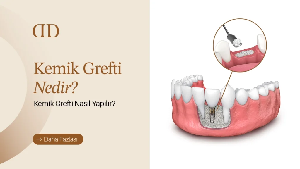 kemik grefti