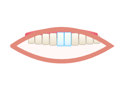 After Laminate Veneers