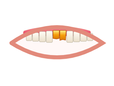 Before Laminate Veneers