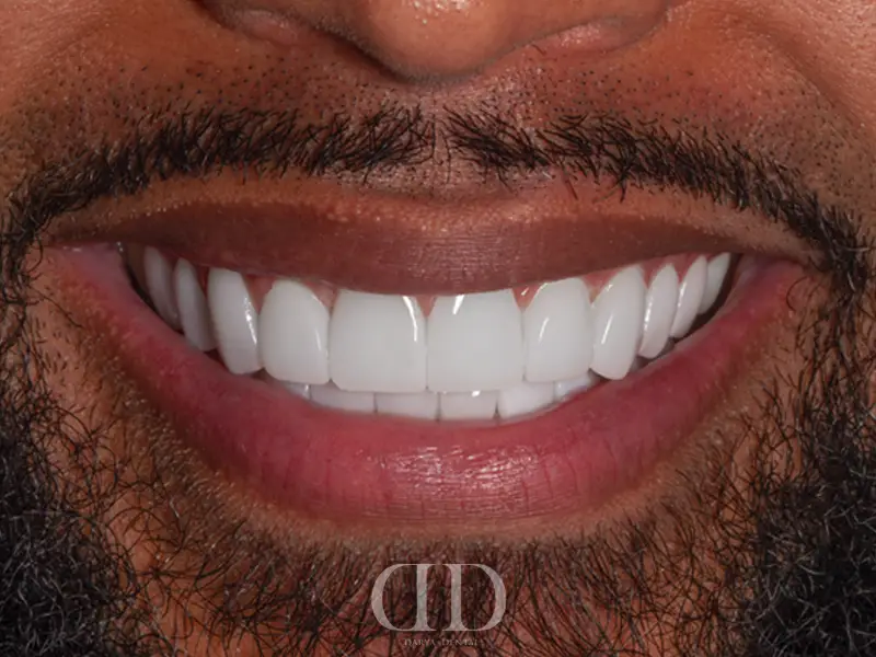 After Laminate Veneers