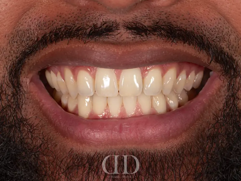 Before Laminate Veneers