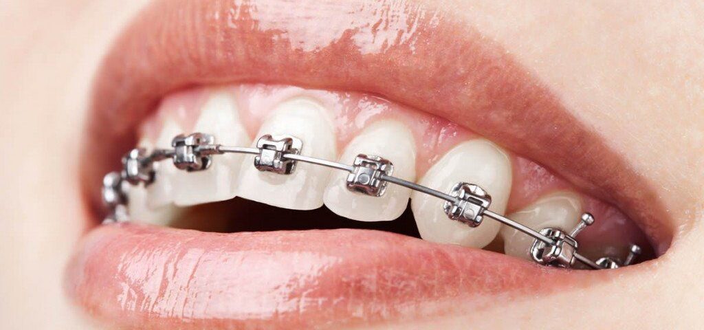 metal braces