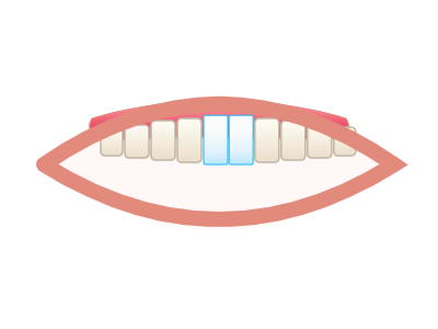 After No-Prep Veneers