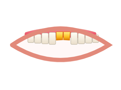 Before No-Prep Veneers