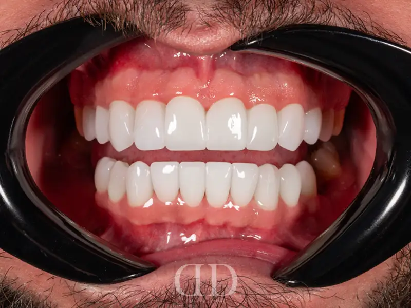 After No-Prep Veneers