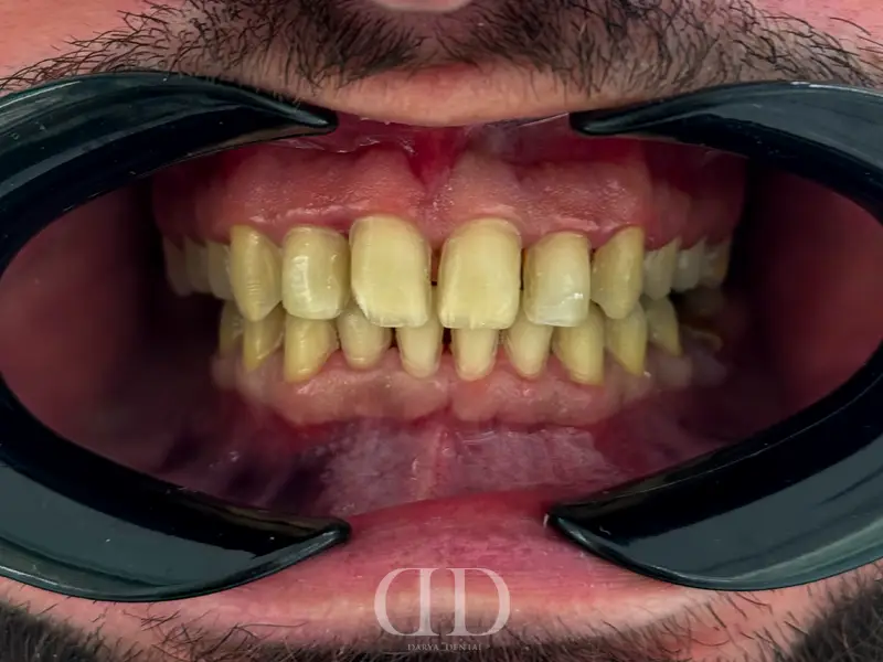 Before No-Prep Veneers
