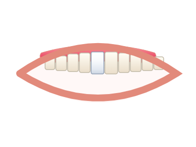 After Porcelain Crowns
