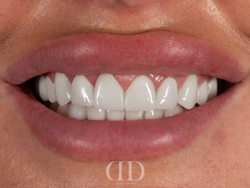 After Porcelain Crowns