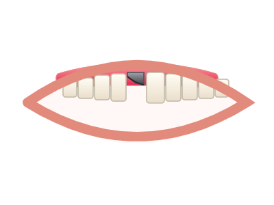 Before Porcelain Crowns