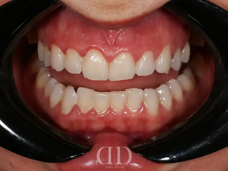 Before Porcelain Crowns