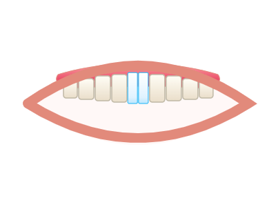 After Porcelain Veneers