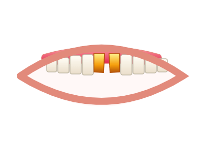 Before Porcelain Veneers