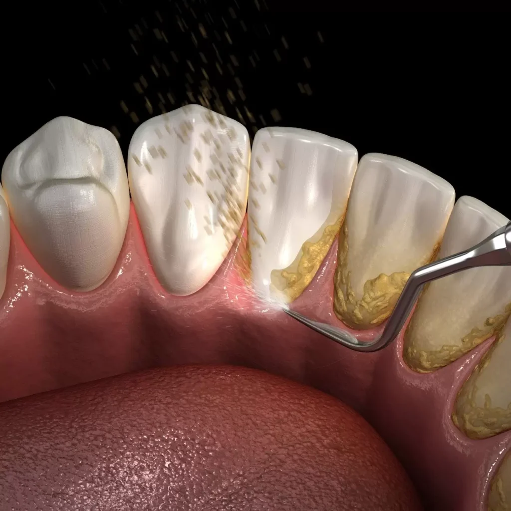 Illustration showing ways to remove tartar from teeth with proper oral care