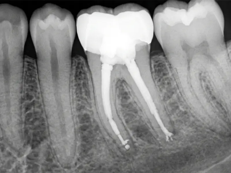 After Root Canal Treatment