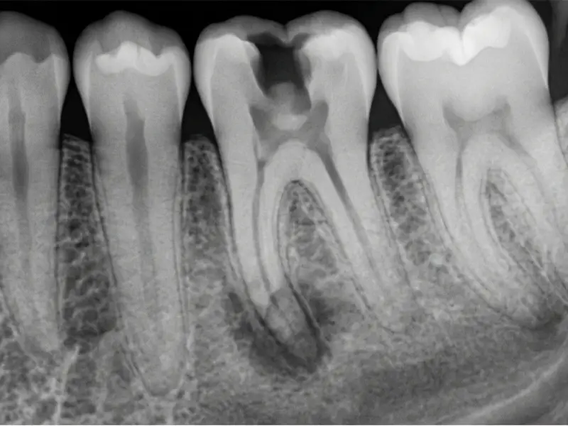 Before Root Canal Treatment