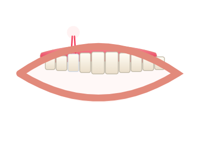 After Root Canal Treatment