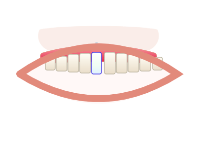 After Same-Day Implant