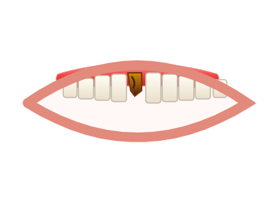 Before Same-Day Implant