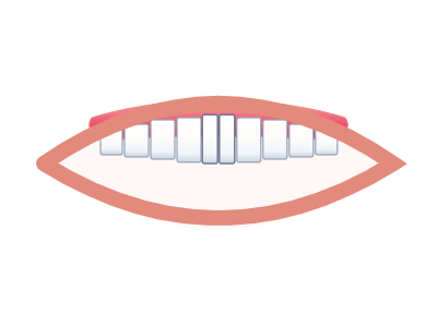 After Smile Makeover