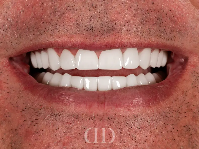 After Smile Makeover