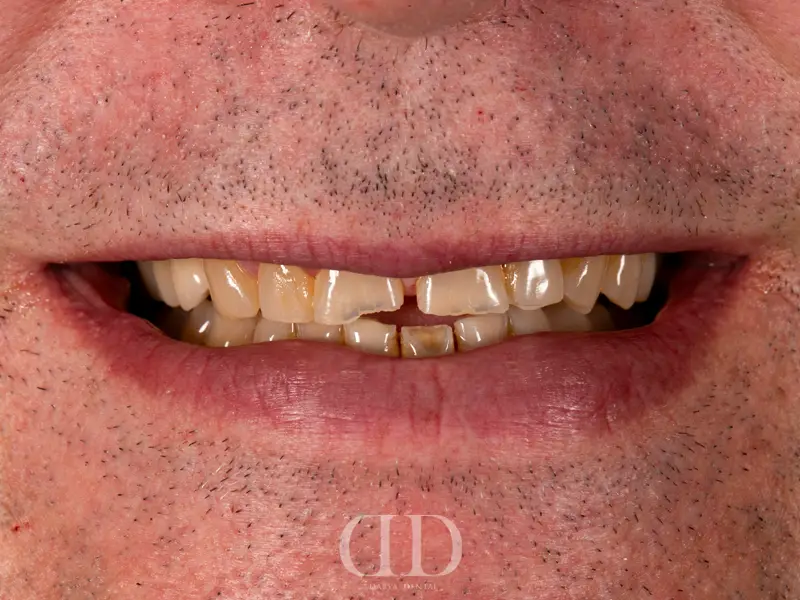 Before Smile Makeover