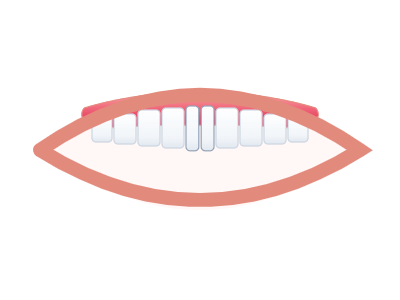 After Teeth Whitening