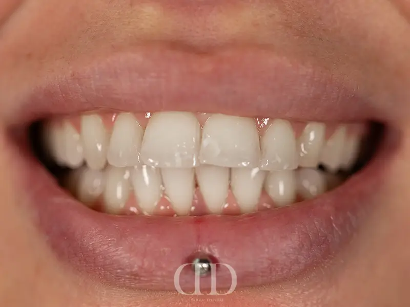 Teeth Whitening After Treatment