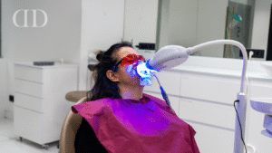 Teeth whitening before veneers or dental crowns