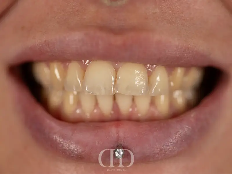 Teeth Before Whitening Treatment