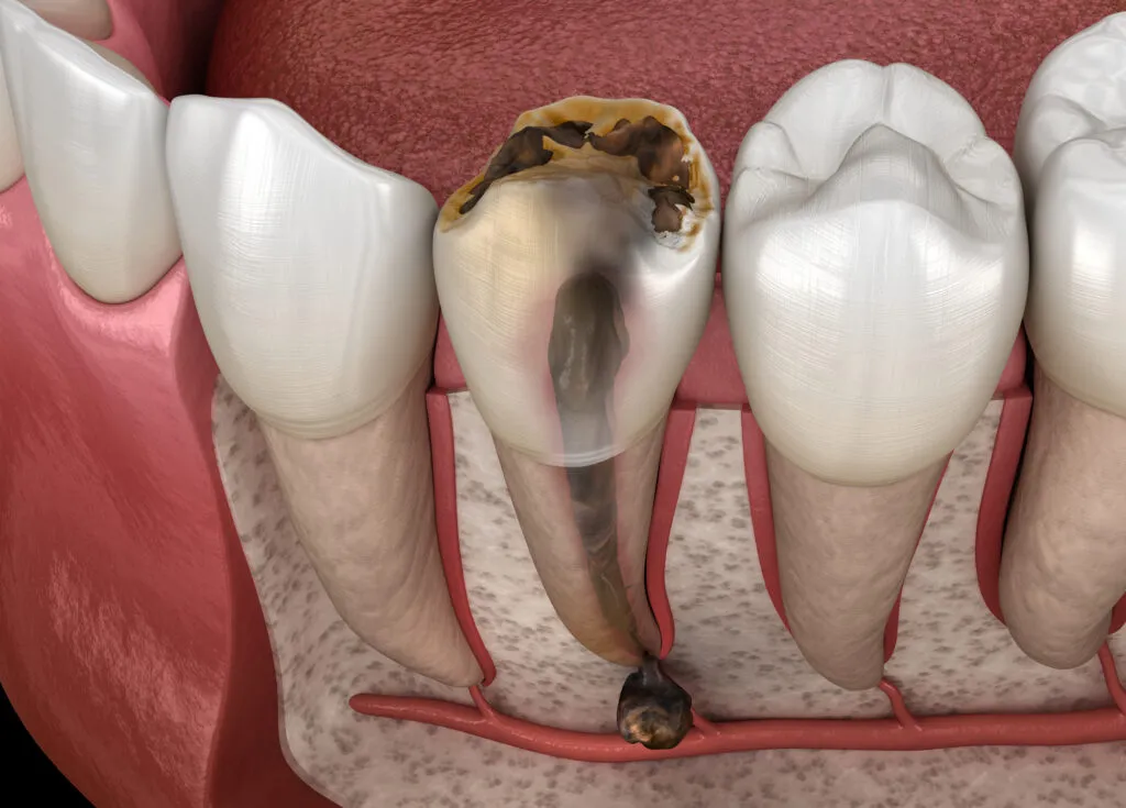 tooth decay