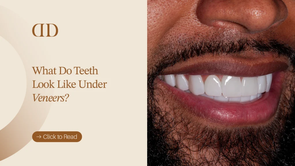 Illustration explaining what natural teeth can look like beneath dental veneers