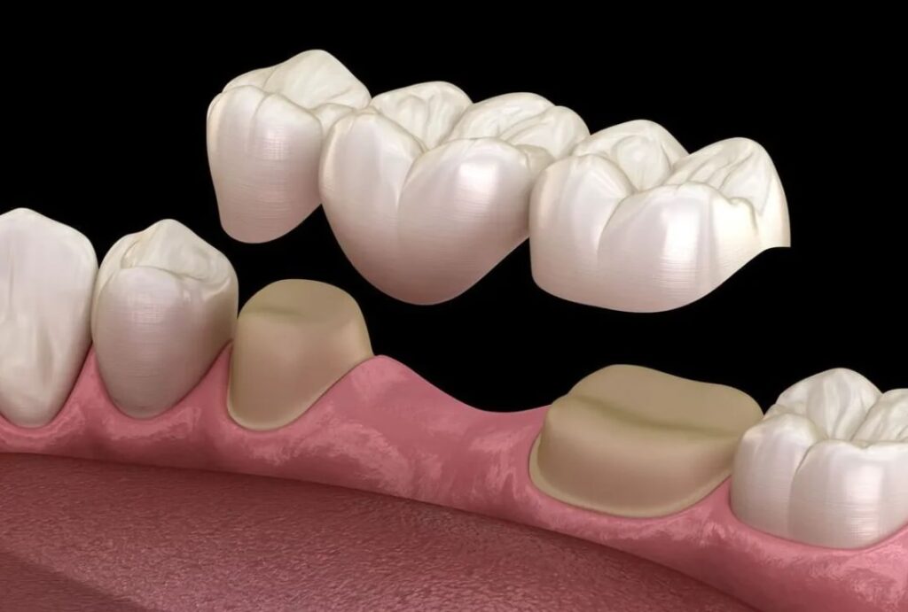 Dental Bridge