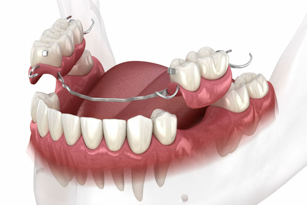 What is a dental flipper code – reference to dental billing code for temporary removable partial dentures