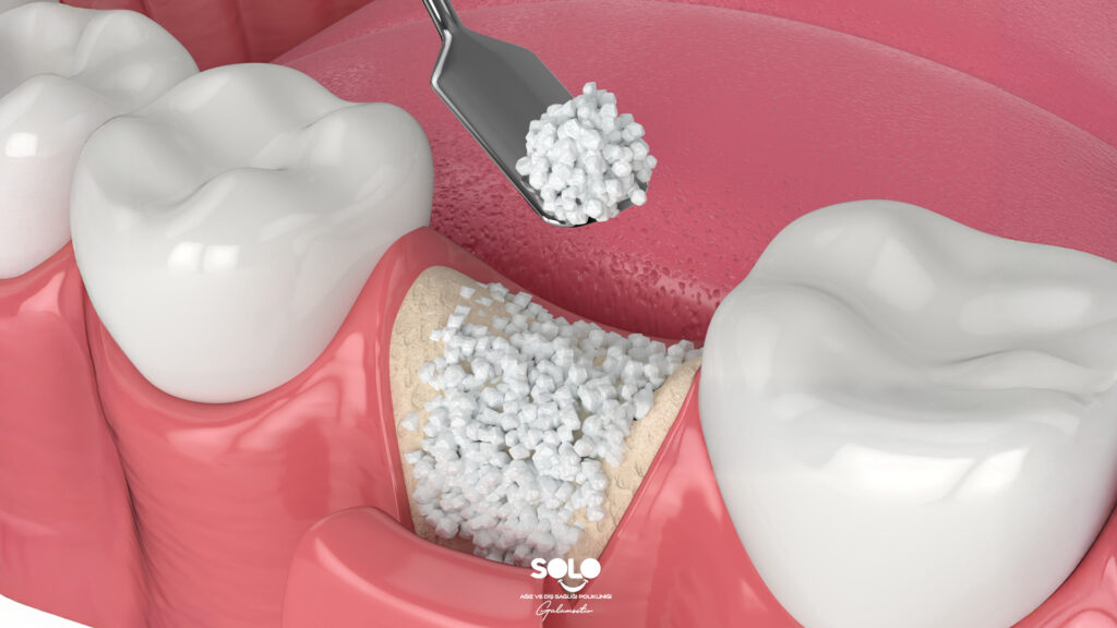 bone grafting