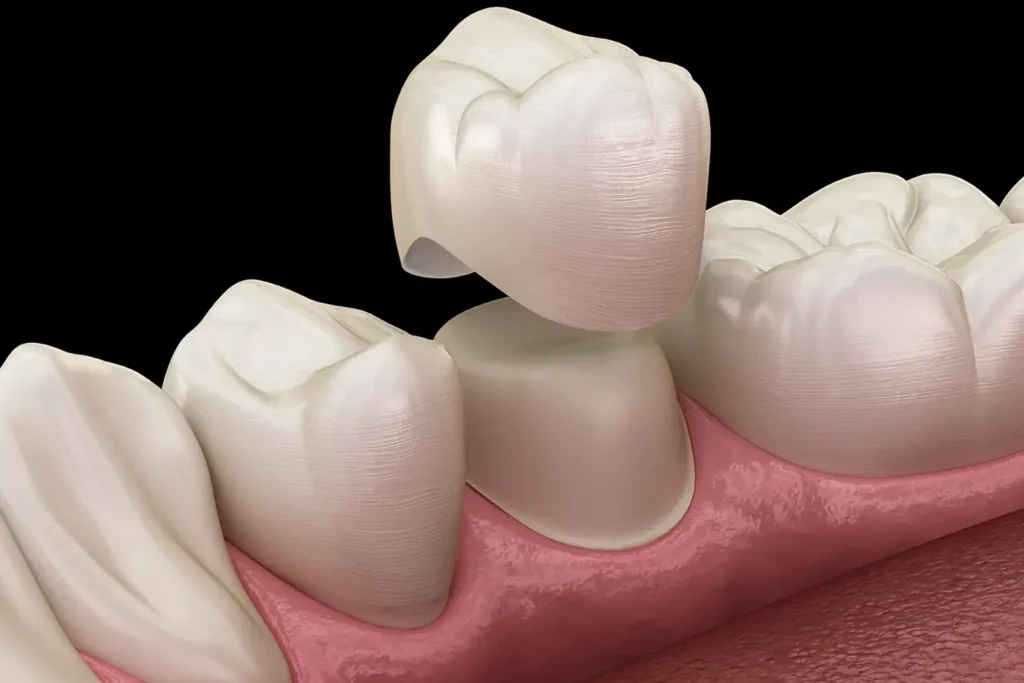 cerec crowns