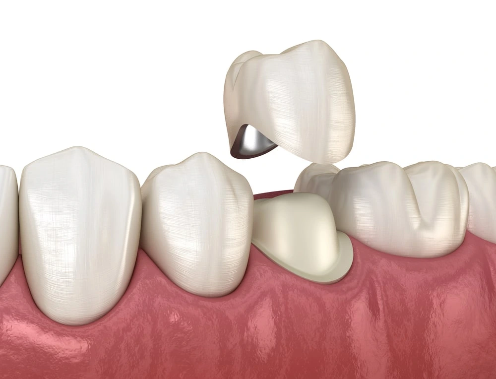 cerec crowns