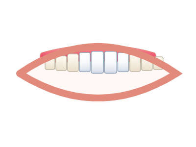 After Zirconia Crowns