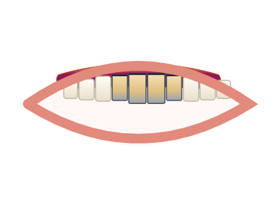 Before Zirconia Crowns