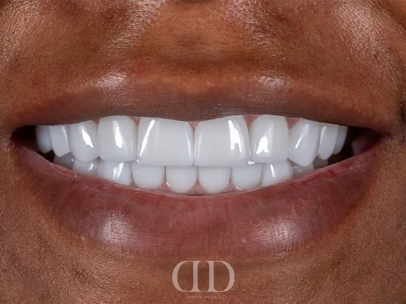 After Zirconia Crowns