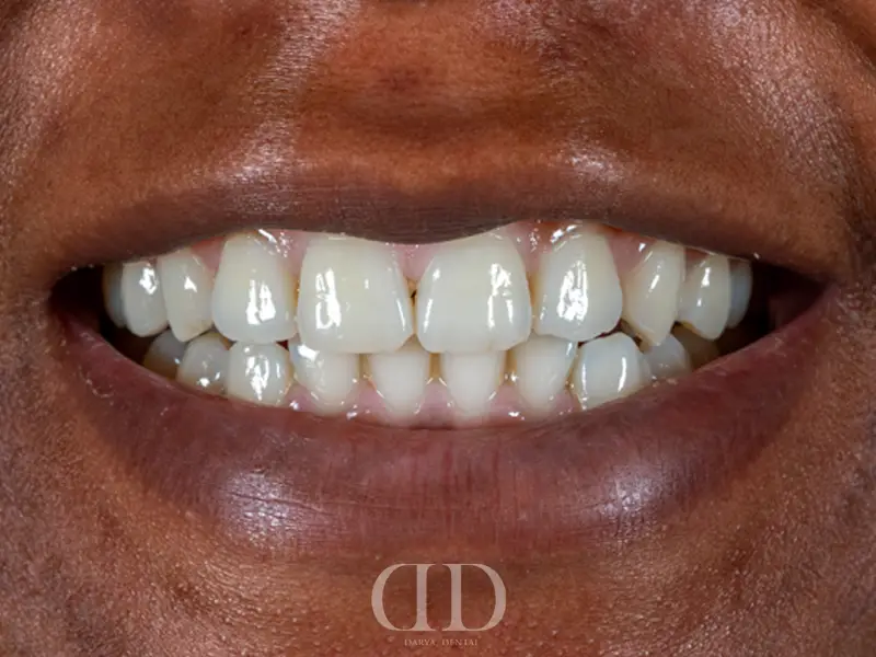 Before Zirconia Crowns