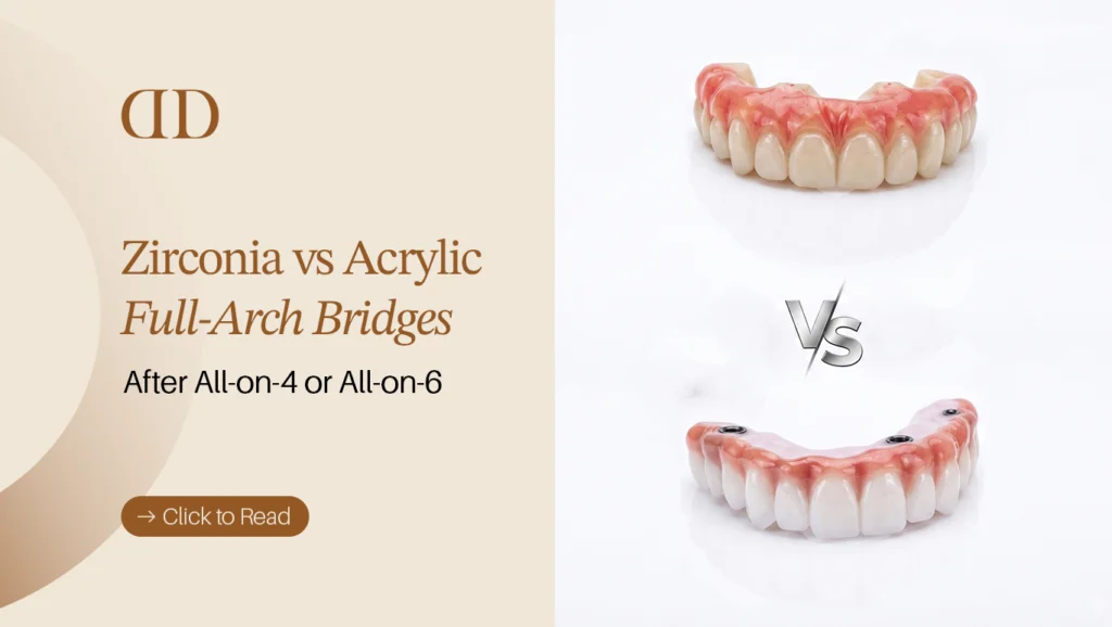 Zirconia vs Acrylic Full-Arch Bridges After All-on-4 or All-on-6