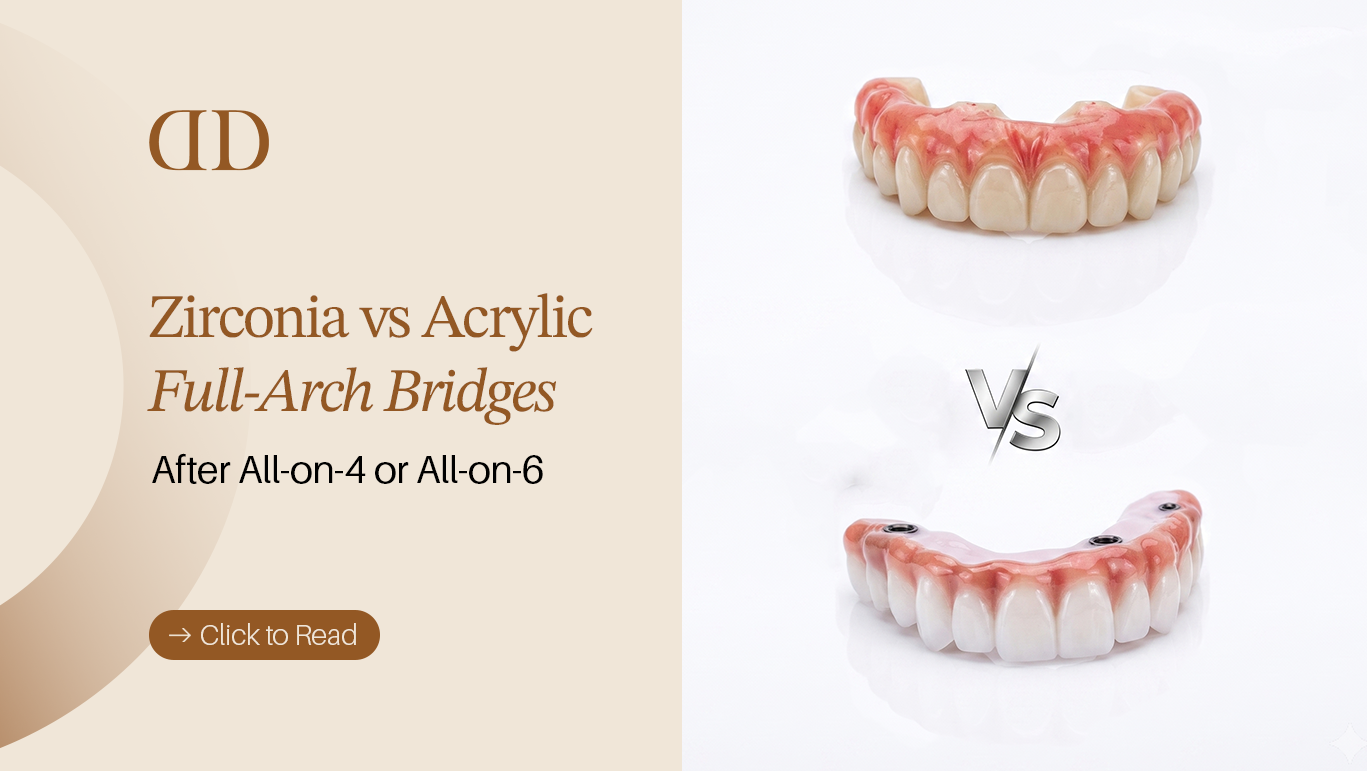 Zirconia vs Acrylic Full-Arch Bridges After All-on-4 or All-on-6